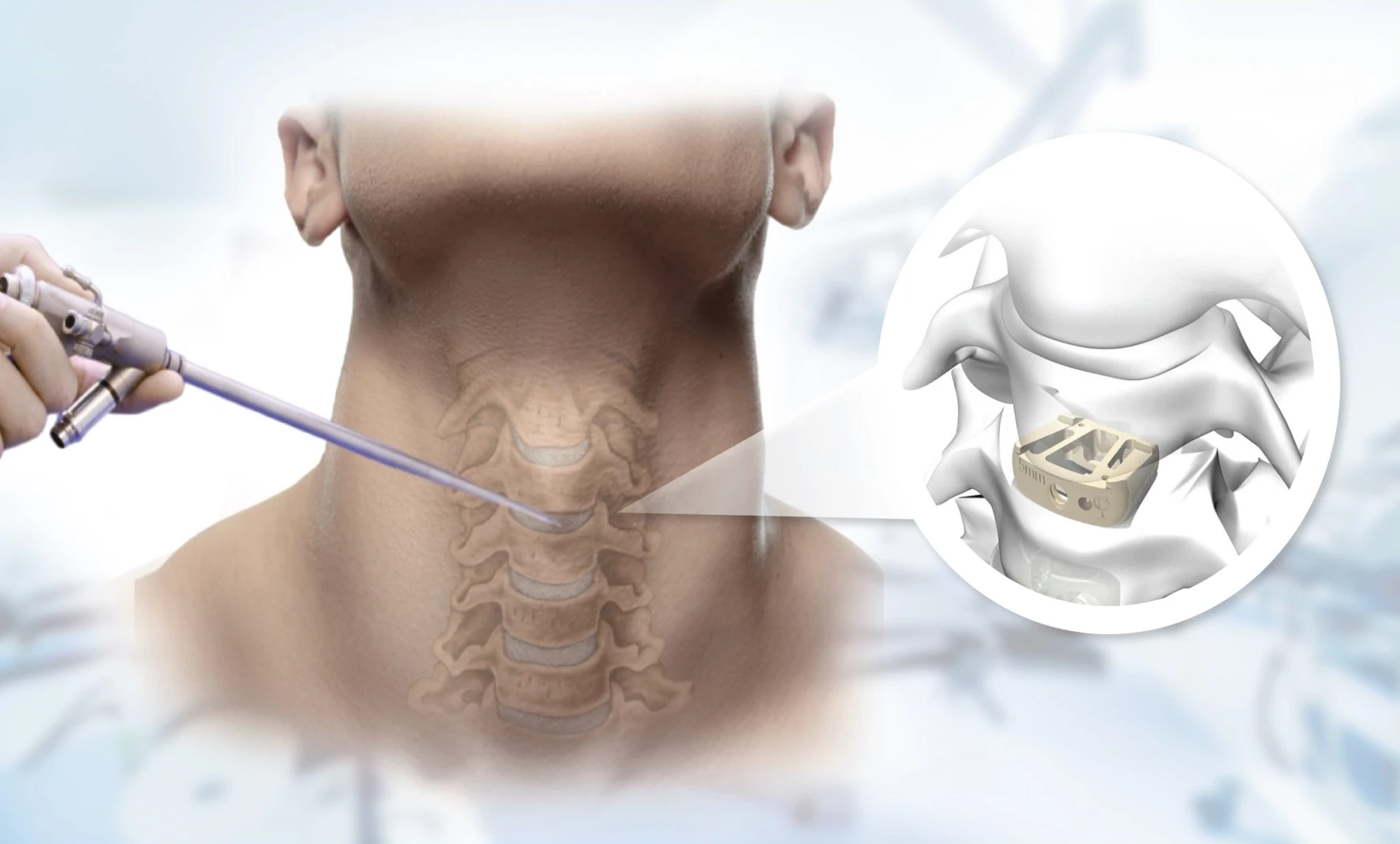 Endoscopic ACDF