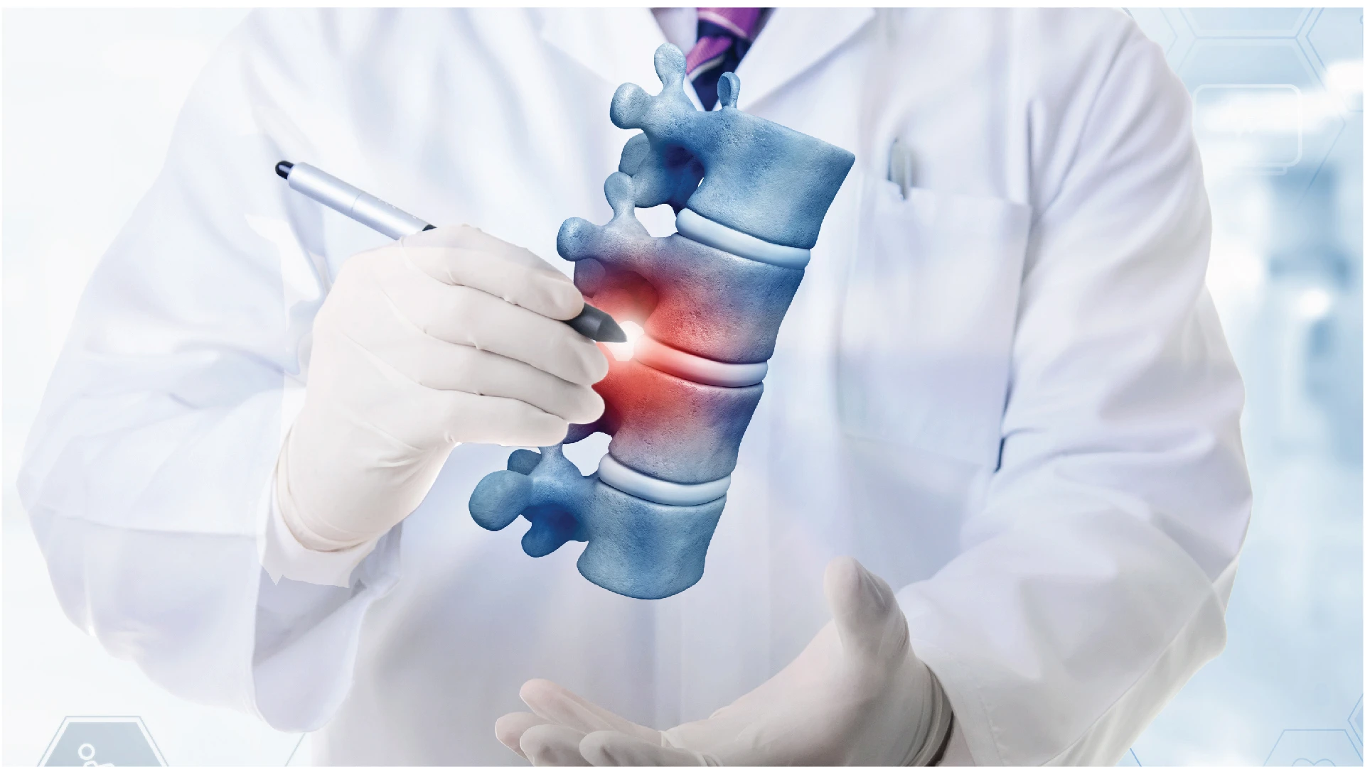 Posterior Spinal Lumbar Discectomy (PSLD) 
